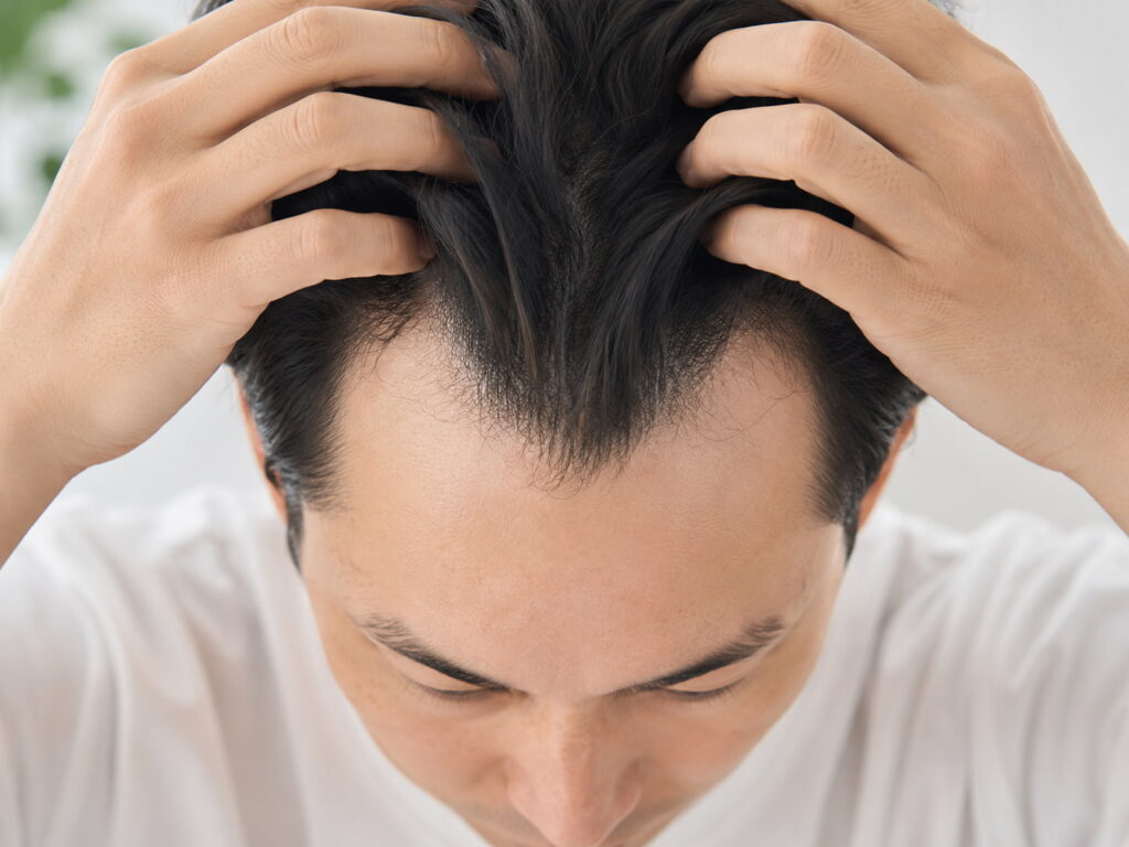 M字が気になる男性へ｜初期サインと確認ポイント