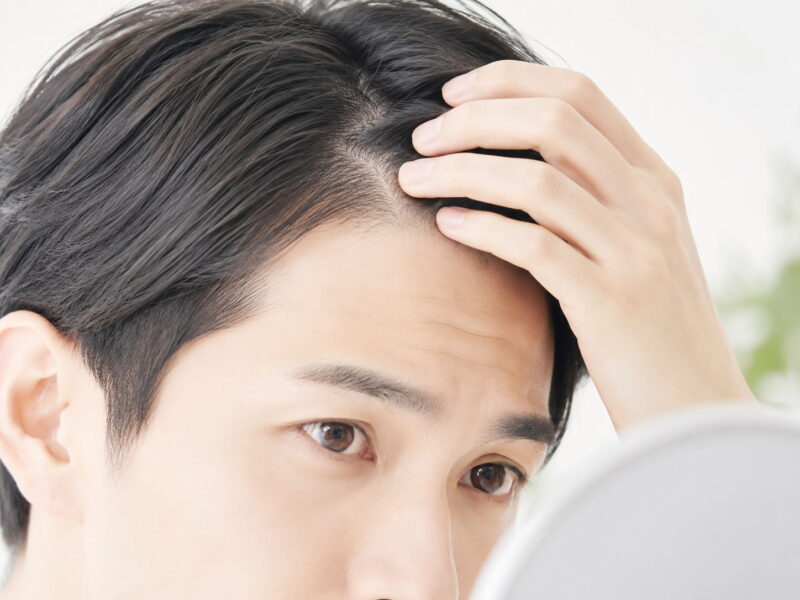 生え際が後退しているか確認する方法