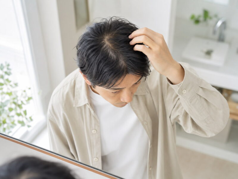 頭頂部が薄いかもと思ったときの確認ポイント